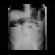 Colorectal cancer, carcinoma of descendens, ileus: X-ray - Plain radiograph